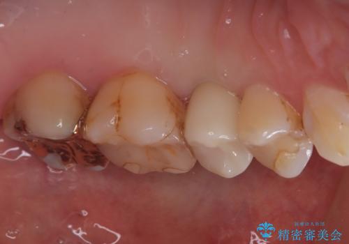 歯が割れてしまった インプラント治療で噛めるように!の治療後