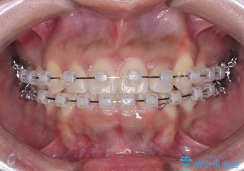 非抜歯で短期間!ワイヤー矯正で理想の歯並びを実現の治療中