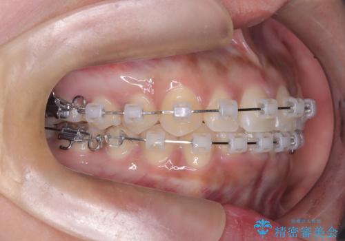 非抜歯で短期間!ワイヤー矯正で理想の歯並びを実現の治療中