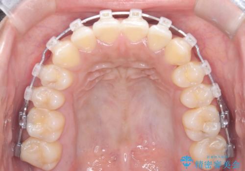非抜歯で短期間!ワイヤー矯正で理想の歯並びを実現の治療中