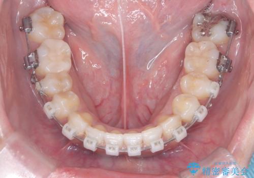 非抜歯で短期間!ワイヤー矯正で理想の歯並びを実現の治療中