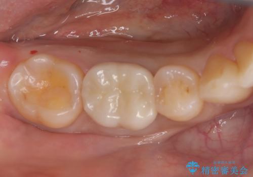 ズキズキ痛い歯 オールセラミッククラウンによる修復の症例 治療前