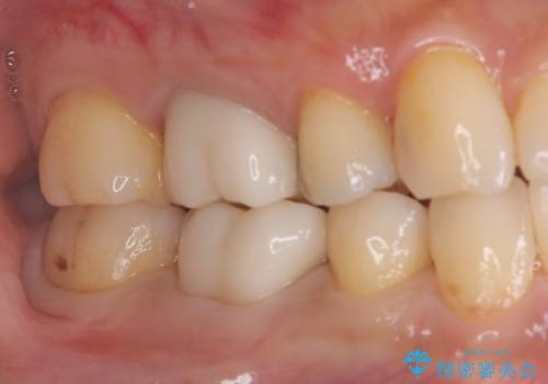ズキズキ痛い歯 オールセラミッククラウンによる修復の治療前