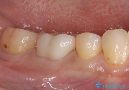 ズキズキ痛い歯 オールセラミッククラウンによる修復の治療前