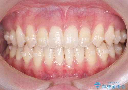 再矯正 前歯のガタツキをマウスピース矯正で治療したいの治療中