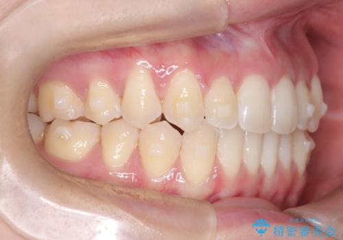 再矯正 前歯のガタツキをマウスピース矯正で治療したいの治療中