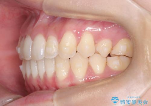 再矯正 前歯のガタツキをマウスピース矯正で治療したいの治療中