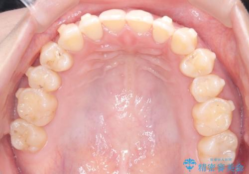 再矯正　前歯のガタツキをマウスピース矯正で治療したいの治療中