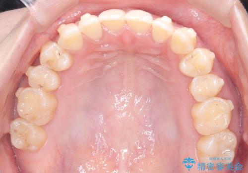 再矯正 前歯のガタツキをマウスピース矯正で治療したいの治療中