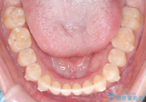 再矯正 前歯のガタツキをマウスピース矯正で治療したいの治療中