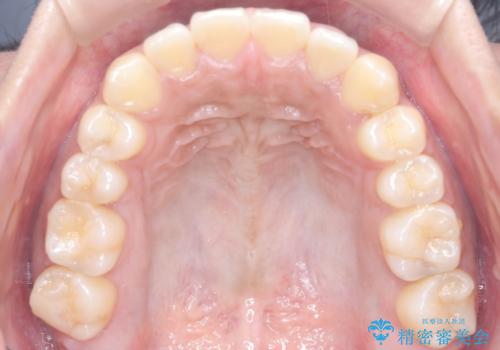 非抜歯で短期間!ワイヤー矯正で理想の歯並びを実現の治療後