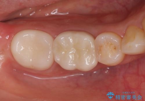 ズキズキ痛い歯 オールセラミッククラウンによる修復の症例 治療後