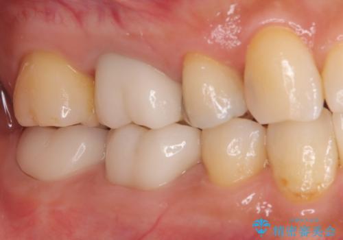 ズキズキ痛い歯 オールセラミッククラウンによる修復の治療後