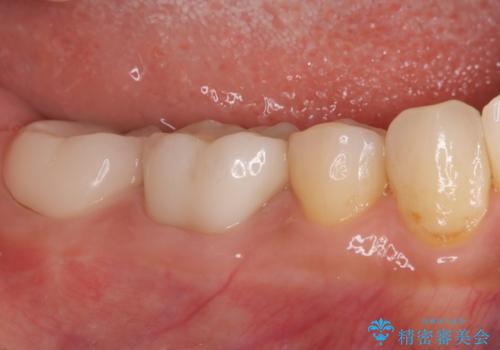 ズキズキ痛い歯 オールセラミッククラウンによる修復の治療後