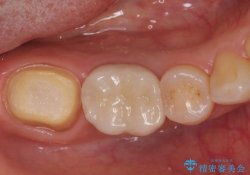 ズキズキ痛い歯 オールセラミッククラウンによる修復の治療中