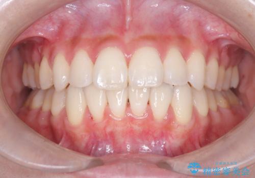 反対咬合を治したい。インビザライン