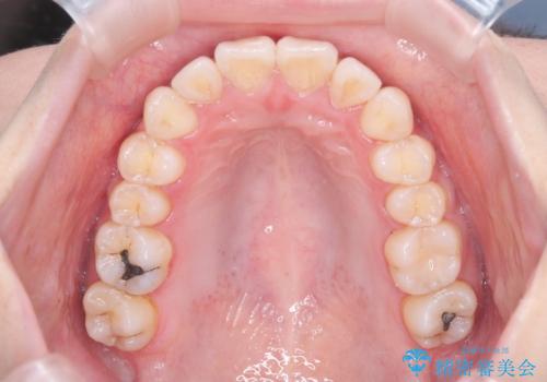 反対咬合を治したい。インビザラインの治療後