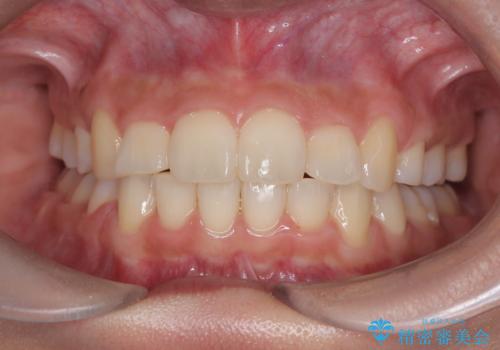 凸凹を綺麗にしたい。表側ワイヤー矯正の症例 治療後