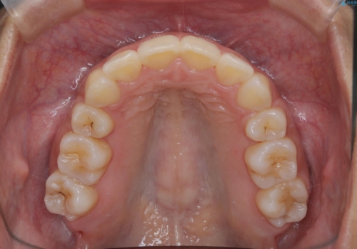凸凹を綺麗にしたい。表側ワイヤー矯正の治療後