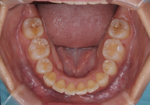 凸凹を綺麗にしたい。表側ワイヤー矯正の治療後