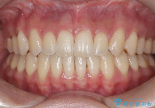再矯正 前歯のガタツキをマウスピース矯正で治療したい