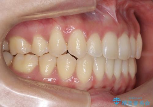 再矯正 前歯のガタツキをマウスピース矯正で治療したいの治療後