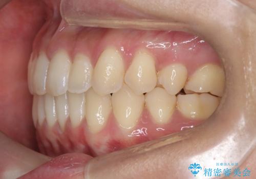 再矯正 前歯のガタツキをマウスピース矯正で治療したいの治療後