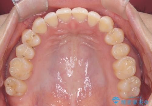 再矯正　前歯のガタツキをマウスピース矯正で治療したいの治療後