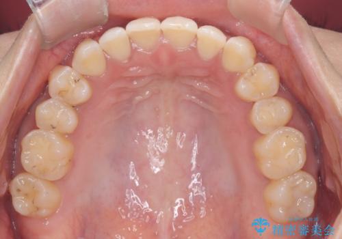 再矯正 前歯のガタツキをマウスピース矯正で治療したいの治療後