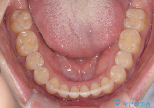 再矯正 前歯のガタツキをマウスピース矯正で治療したいの治療後