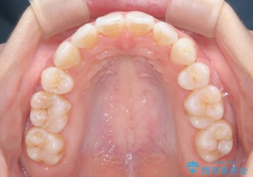 【抜歯インビザ】凸凹を綺麗になおしたいの治療後