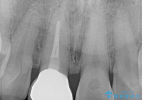 前歯のセラミックをやり替えたいの治療後