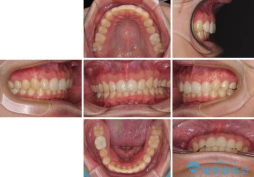 ねじれの強い前歯と奥歯　インビザラインでの矯正治療の治療後