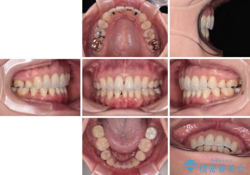 前方に飛び出した前歯　ワイヤー装置での抜歯矯正の治療後
