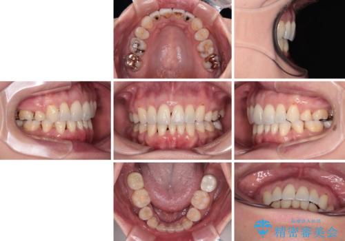 前方に飛び出した前歯 ワイヤー装置での抜歯矯正の治療後