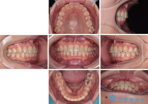 八重歯を治す　非抜歯のワイヤー矯正治療の治療後