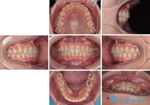 八重歯を治す 非抜歯のワイヤー矯正治療の治療後