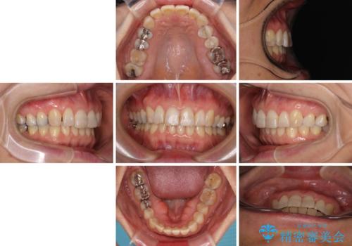 インビザラインが続けられない　忍耐のマウスピース矯正の治療後