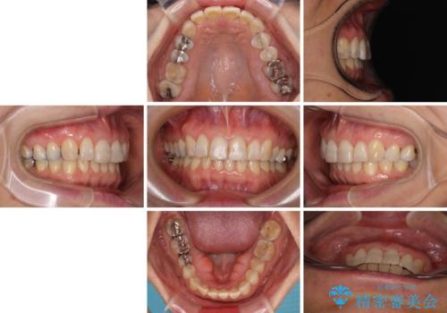インビザラインが続けられない 忍耐のマウスピース矯正の治療後