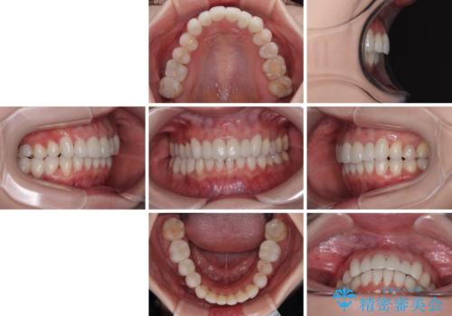 気にしていた歯並びをインビザラインで改善 セラミックも作り替えて綺麗な口元にの治療後