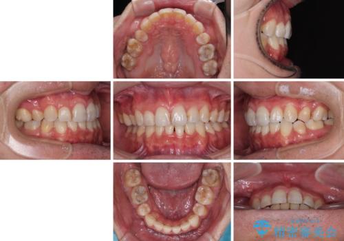 顎が左右にずれた咬み合わせ ハーフリンガルの抜歯矯正の治療後