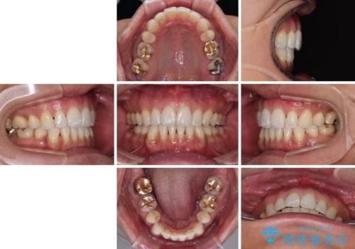 【モニター】口が閉じにくい　抜歯矯正でスッキリした口元にの治療後