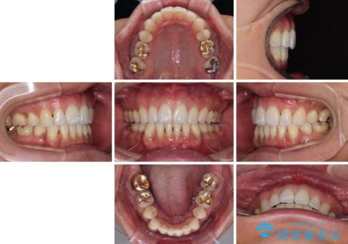 【モニター】口が閉じにくい 抜歯矯正でスッキリした口元にの治療後