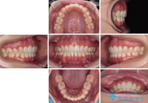 閉じにくい口元をワイヤー抜歯矯正でスッキリした口元にの治療後
