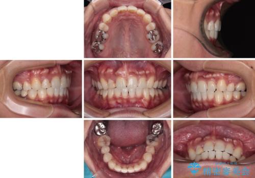 【モニター】八重歯と正中のずれた歯列　片顎抜歯のワイヤー矯正の治療後