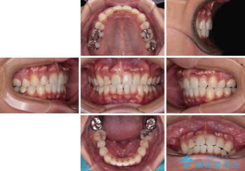 【モニター】八重歯と正中のずれた歯列 片顎抜歯のワイヤー矯正の治療後