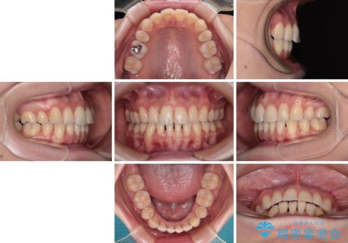 【モニター】飛び出した上顎前歯を抜歯矯正で引っ込める　ワイヤー装置の抜歯矯正治療の治療後