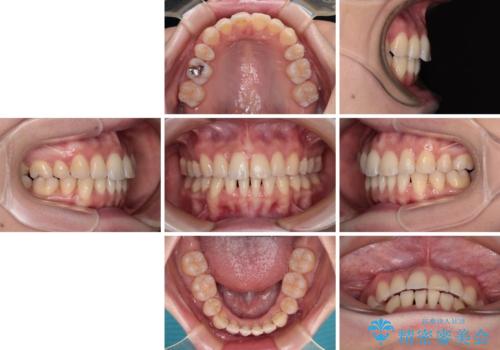 【モニター】飛び出した上顎前歯を抜歯矯正で引っ込める ワイヤー装置の抜歯矯正治療の治療後
