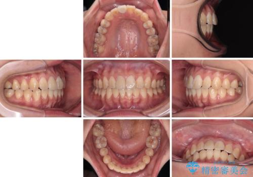舌の突出癖による開咬と前歯の突出 インビザライン矯正治療の治療後