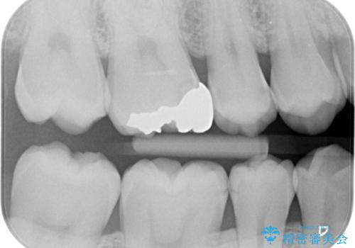 銀歯を白くしたい。の治療前